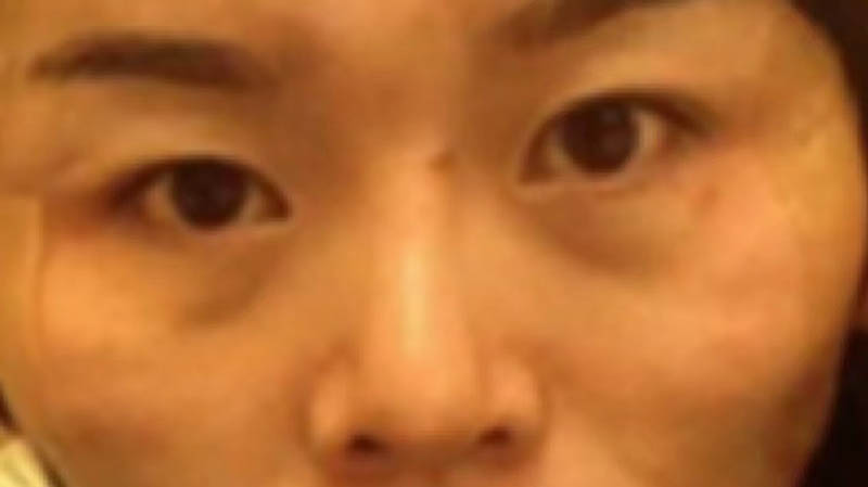 治疗后